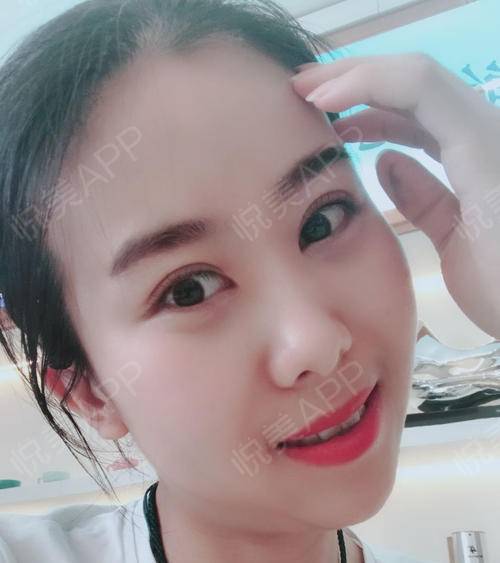 眼睛一點(diǎn)點(diǎn)恢復(fù)，越來(lái)越好看 眼部多項(xiàng)手術(shù)的蛻變之旅